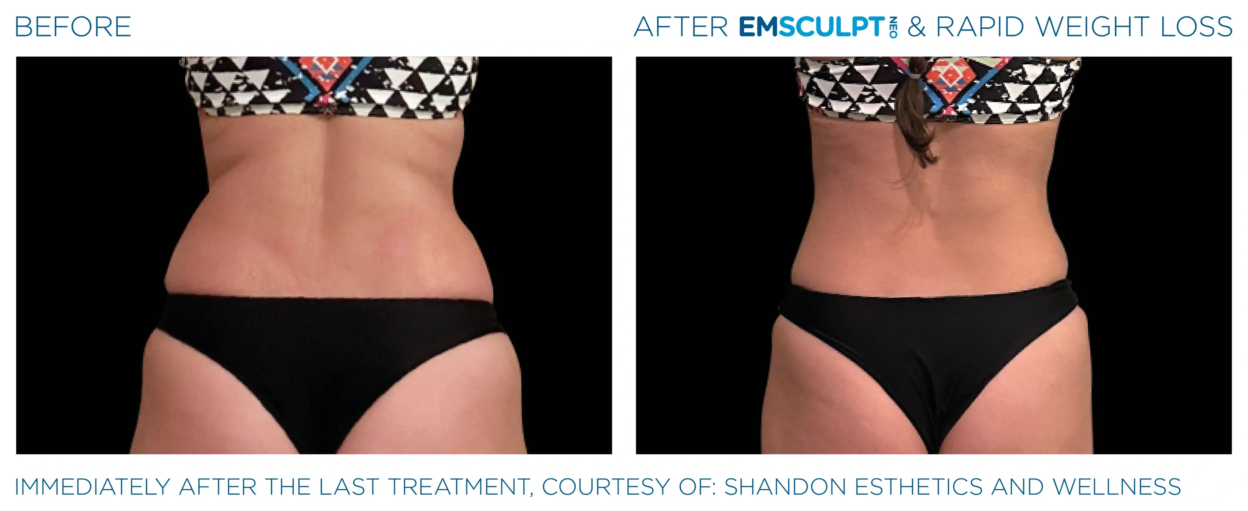 Emsculpt Neo before and after