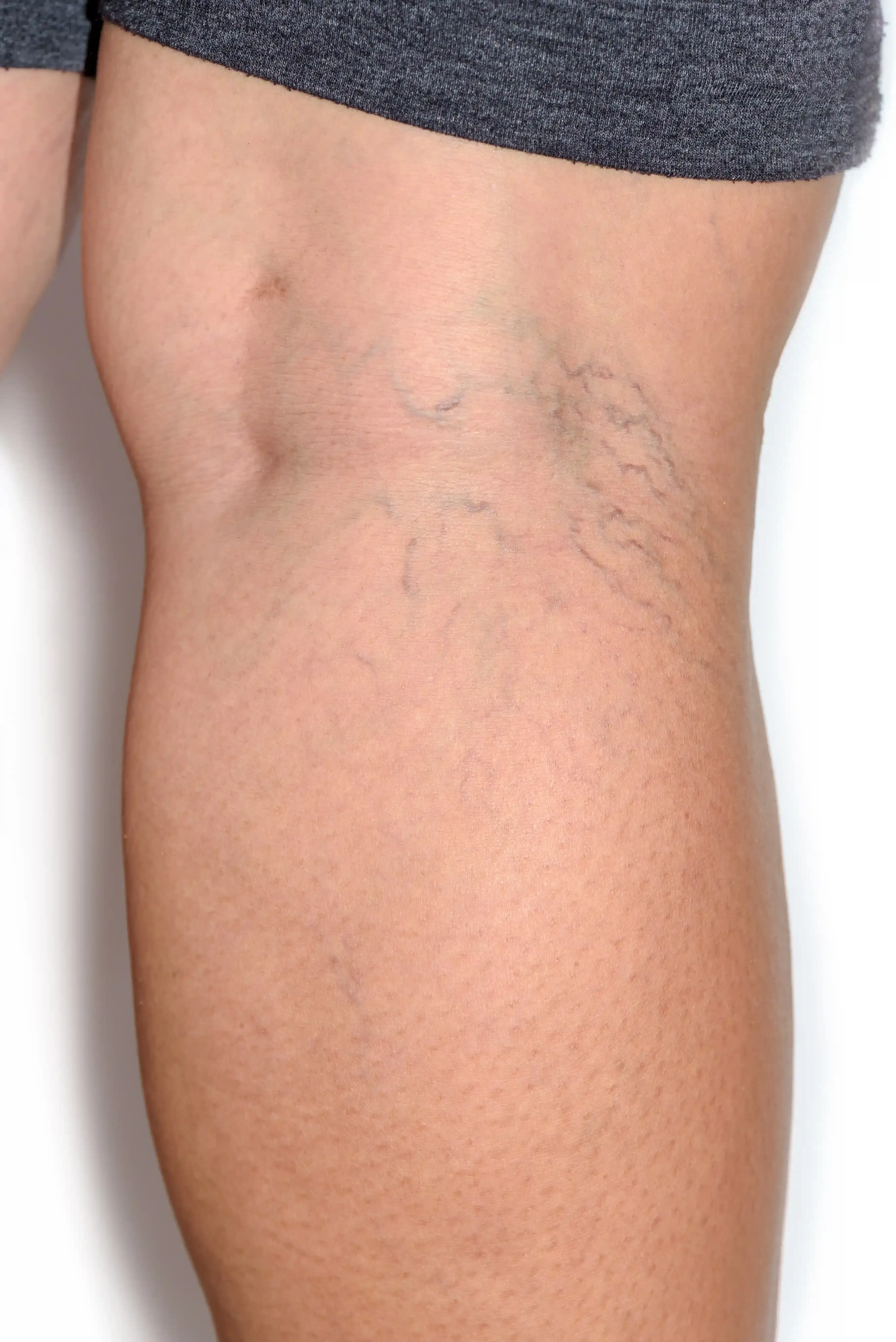 Close-up of spider veins on a lower leg being evaluated before treatment at a Suwanee GA vein center