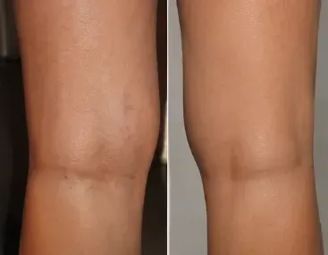 Sclerotherapy before and after