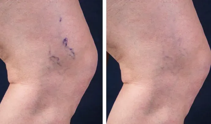 Sclerotherapy before and after