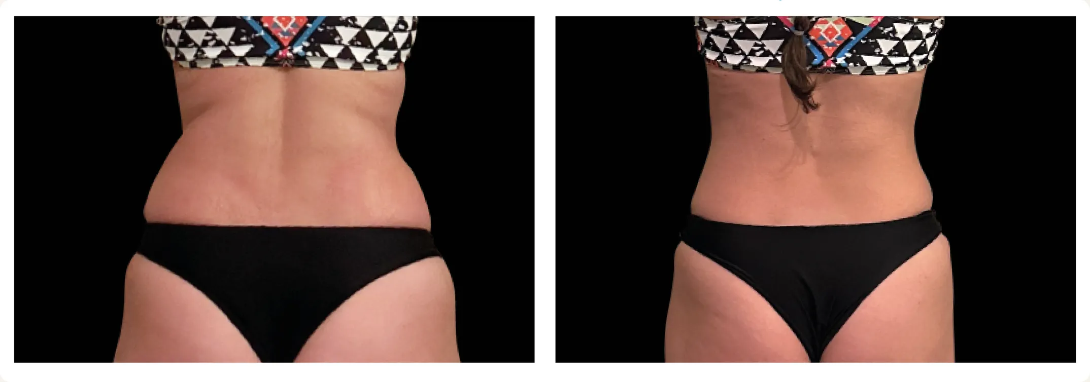 Emsculpt Neo before and after: abdomen and waist of a Bodiatrics patient after body contouring and rapid weight loss