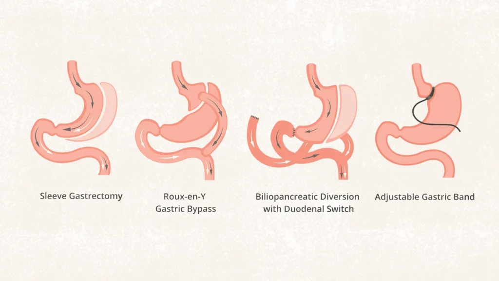 Robotic Bariatric Surgery Georgia