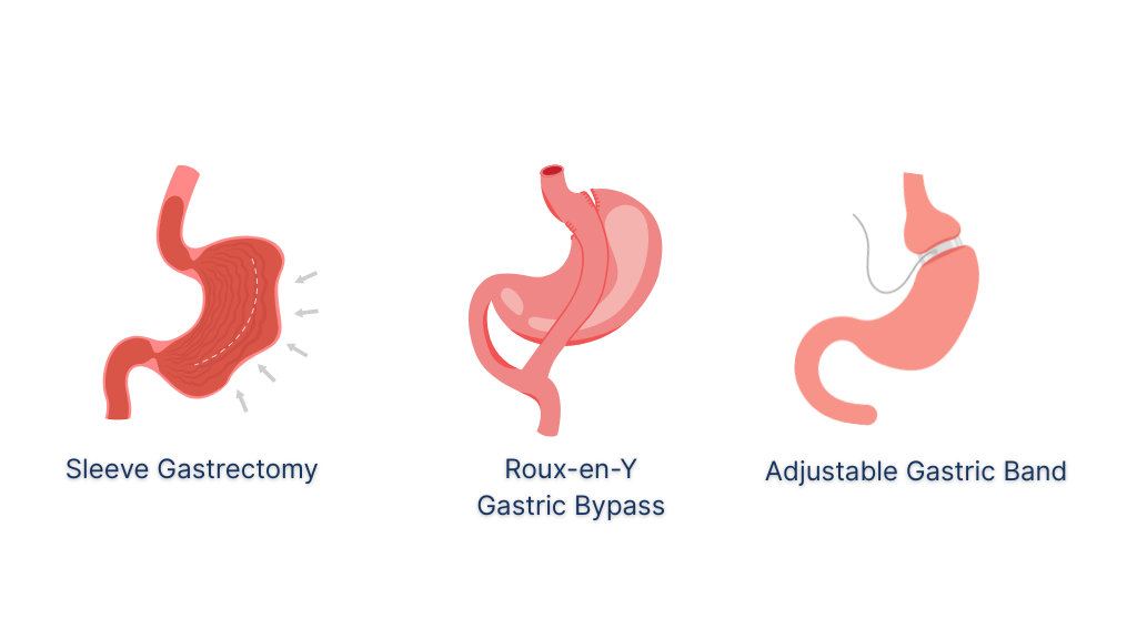 Robotic Bariatric Surgery