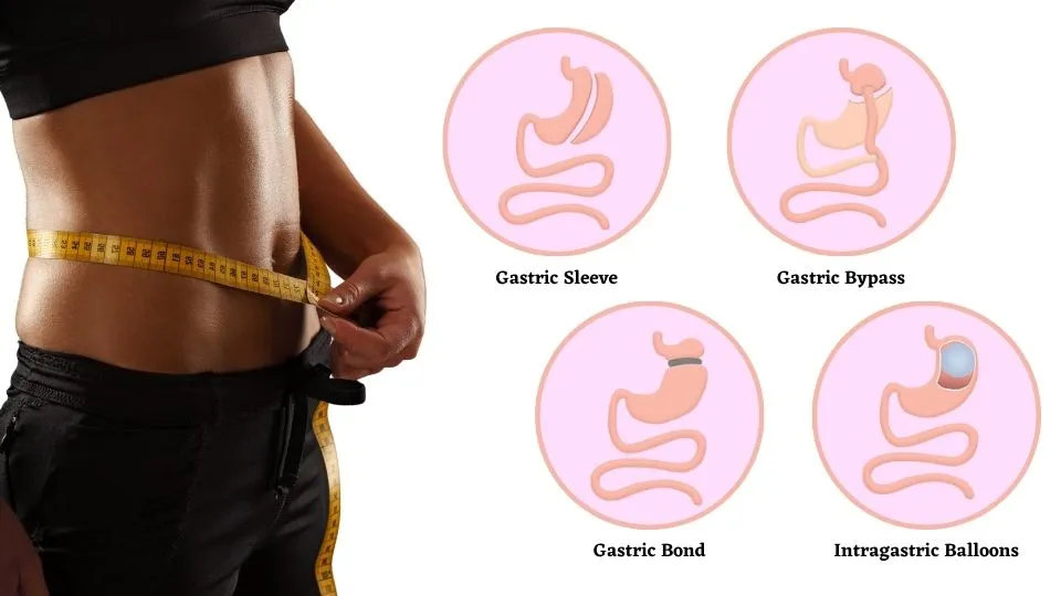 Bariatric Surgery Sandy Springs