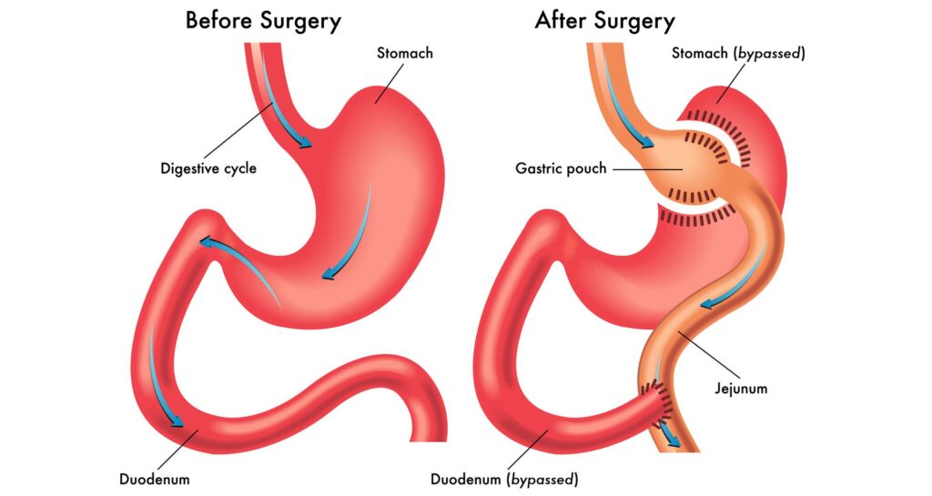 Gastric Sleeve vs. Gastric Bypass – How to Choose the Right Surgery for You