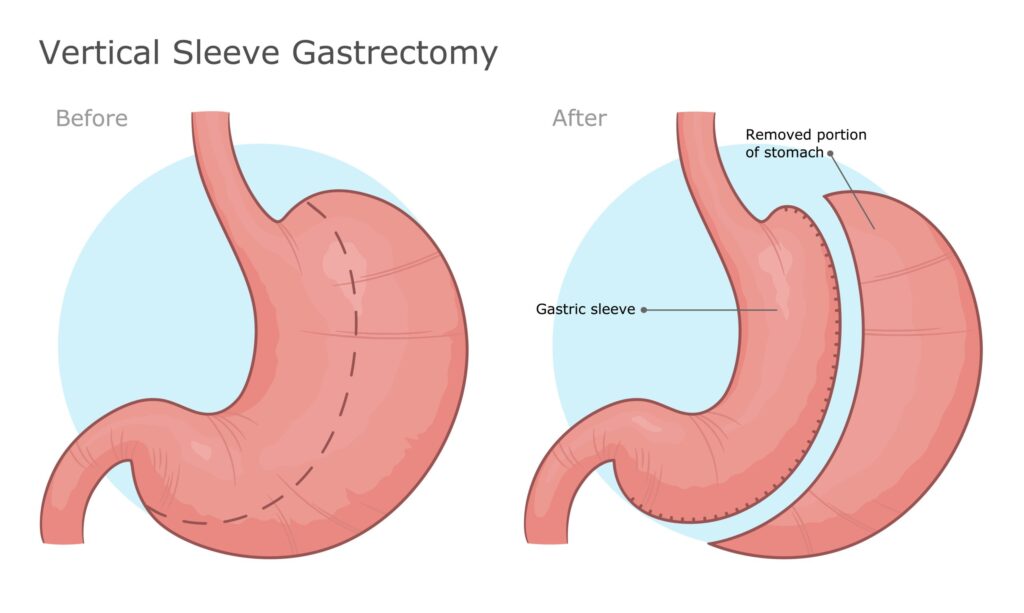 Gastric Sleeve vs. Gastric Bypass – How to Choose the Right Surgery for You