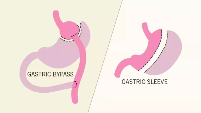 Gastric Sleeve vs. Gastric Bypass – How to Choose the Right Surgery for You