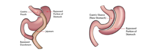 What’s The Recovery Like After Gastric Sleeve Or Bypass?
