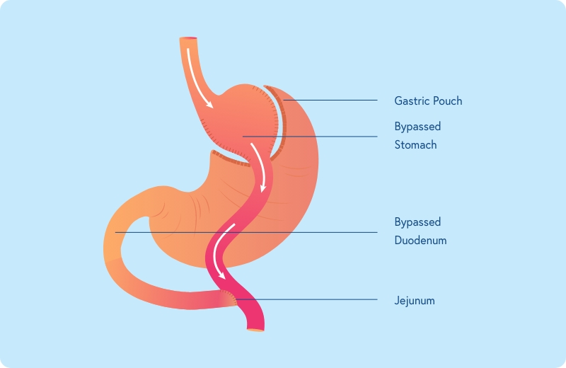 SILS vs Traditional Bariatric Surgery: What Patients in Atlanta Should Know