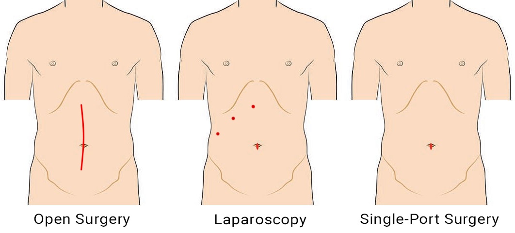 Does Single-Port Surgery Leave Scars? Single Port Surgery — How to Prevent Scarring