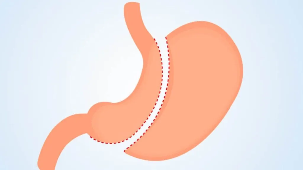 Is Single-Port Gastric Sleeve Safe? Benefits and Risks