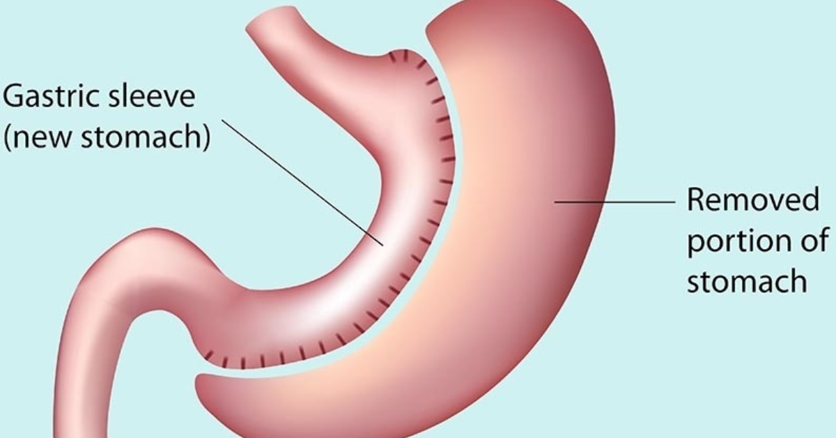 How does no-scar bariatric surgery work? Explained for Georgia patients How does no-scar bariatric surgery work? Explained for Georgia patients