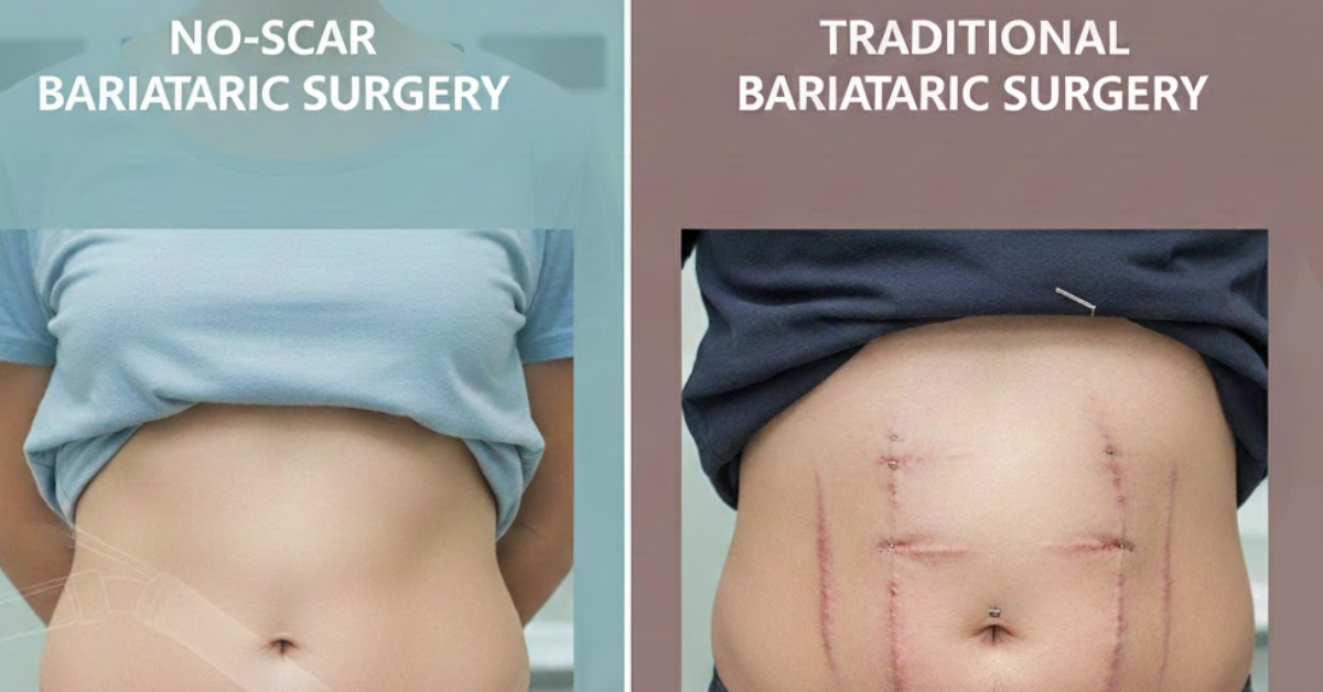 How does no-scar bariatric surgery work? Explained for Georgia patients Comparison Between No-Scar Bariatric Surgery and Traditional Bariatric Surgery